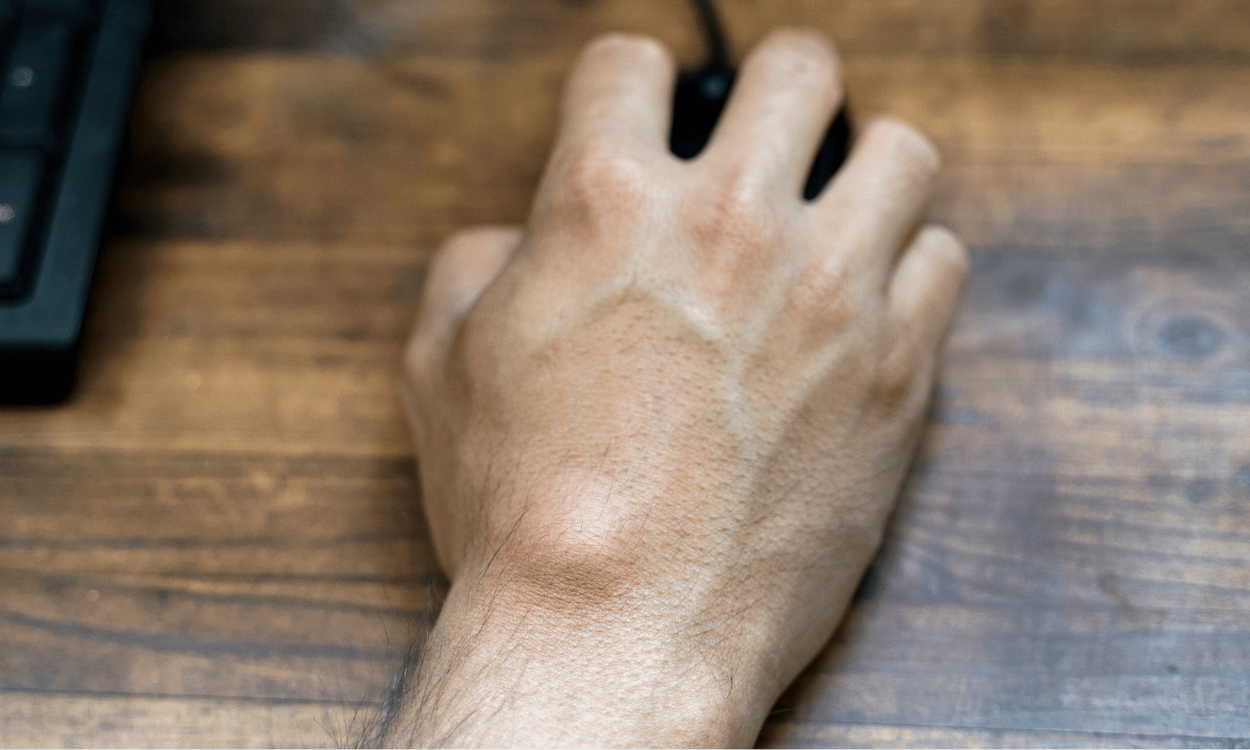 Lipome sous-cutané sur le dos de la main