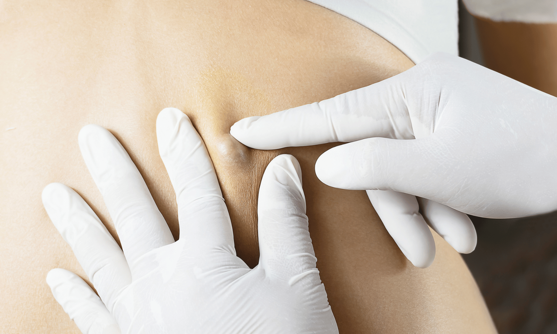 Examen médical d’un lipome sous-cutané sur le dos