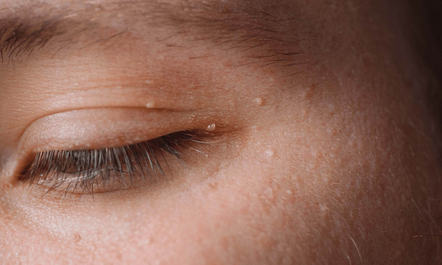 Grains de milium autour de la paupière