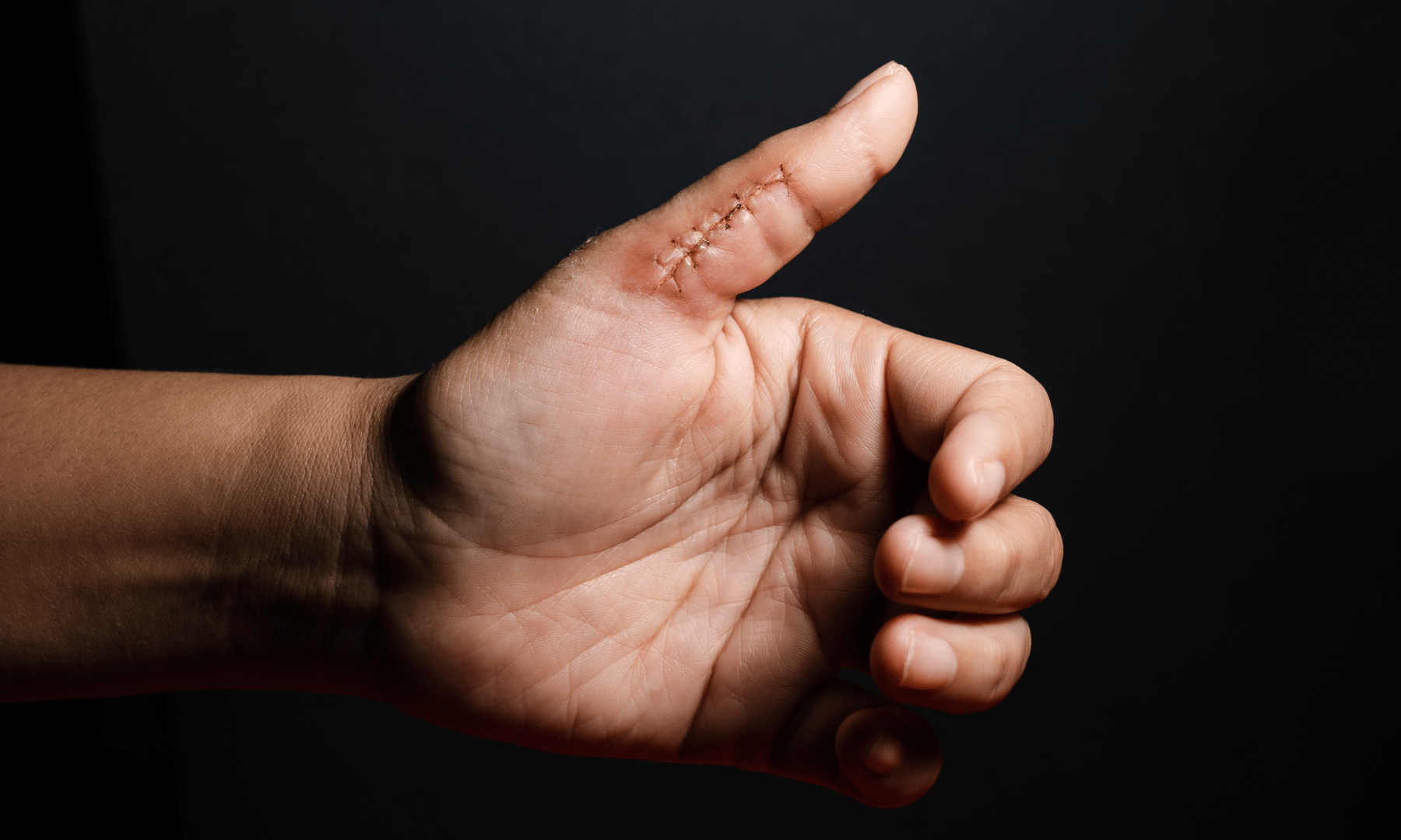 Sutures de plaies en urgence maison abeille
