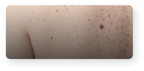 Grains de beauté
