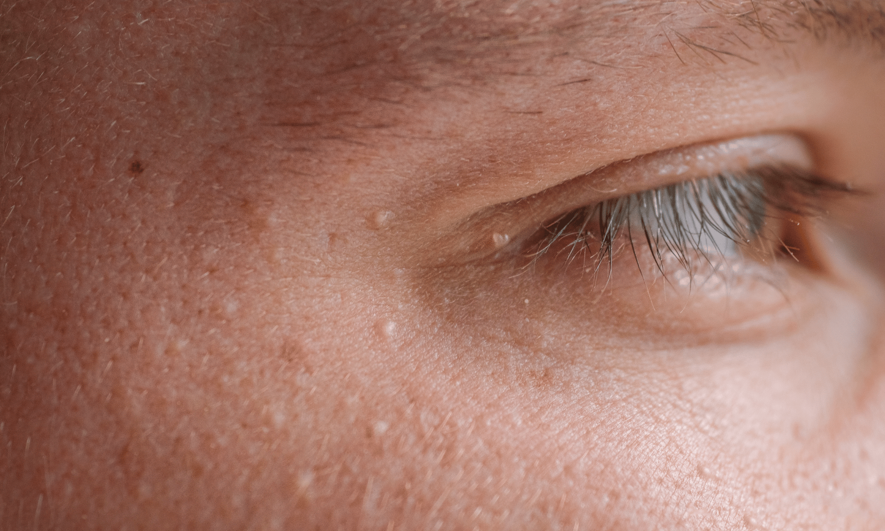 Petits grains de milium sur la peau du visage
