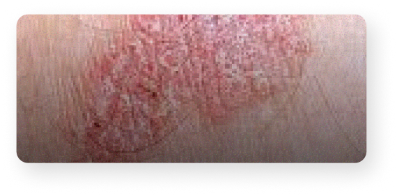 Carcinome
